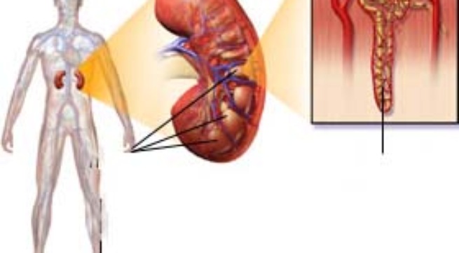 Đái tháo nhạt - Hình ảnh minh họa